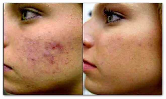 Suffering from Acne Scars? Healthy Natural Ways to Treat ...