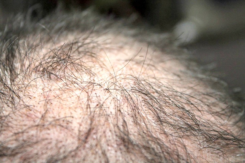 Can You Prevent Age-Related Balding?